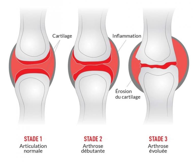 Evolution-arthrose-Gibaud